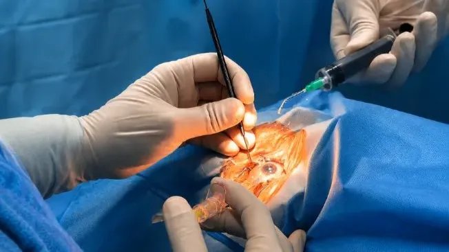 Cataract Surgery
