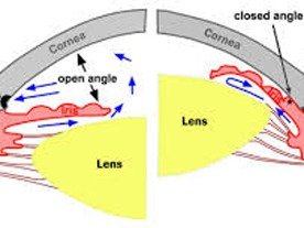 Angle-Closure Glaucoma