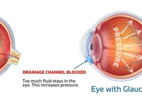 Open-Angle Glaucoma