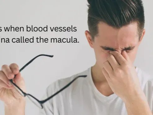 Macular Hole