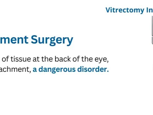Retinal Detachment