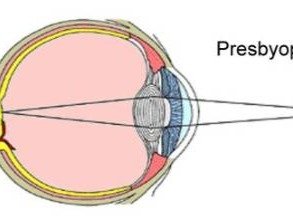 Presbyopia