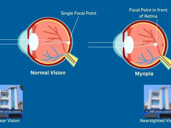Astigmatism