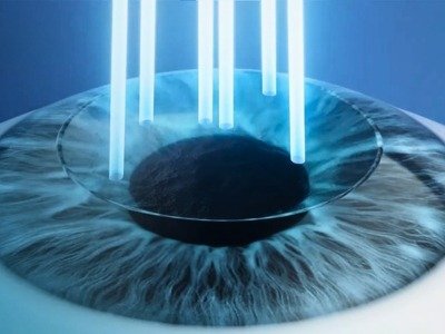 TransPRK LASIK