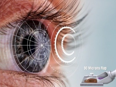SBK LASIK