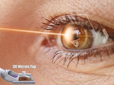 Customized LASIK