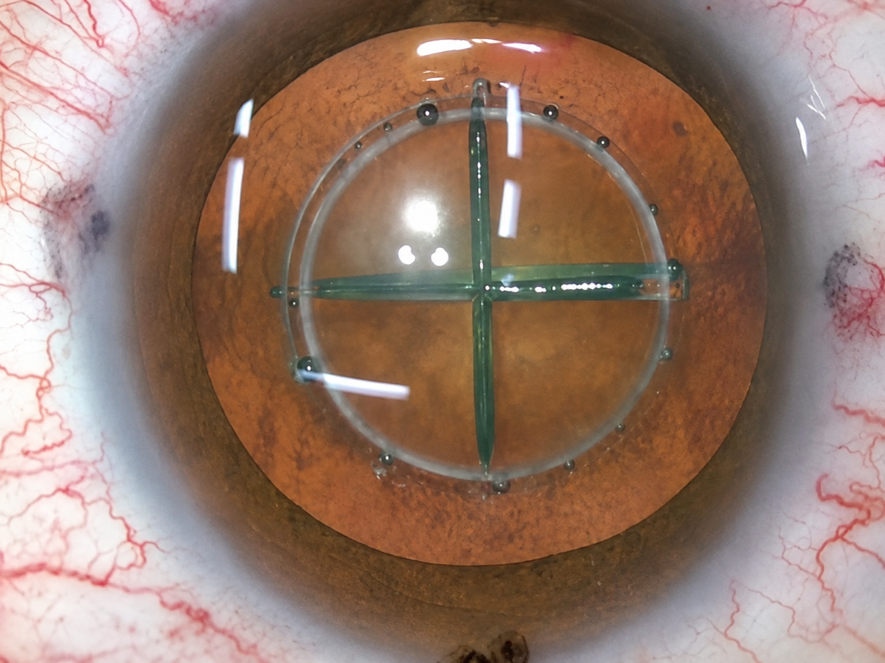 FLACS with Z8 Laser