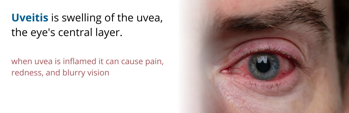 Uveitis Treatment